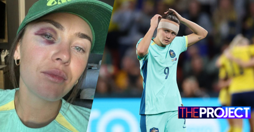 Matildas Striker Caitlin Foord Shows Off Huge Black Eye She Received In Game Against Sweden